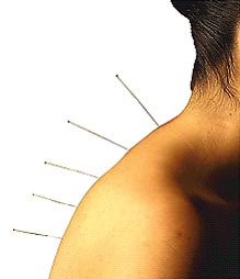 tratamento de acupuntura chinesa