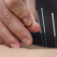 Acupunctura